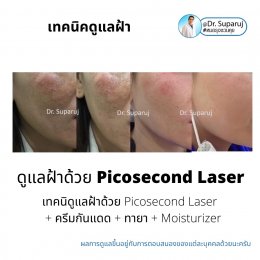 เทคนิคดูแลฝ้าด้วย Picosecond Laser