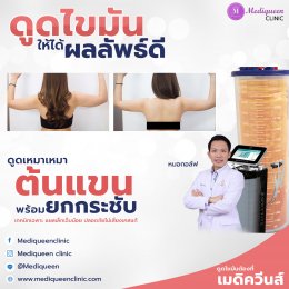 รีวิวดูดไขมันต้นแขน