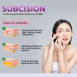 การรักษาหลุมสิวให้หายขาดด้วยการทำ Subcision (ซับซีชั่น)