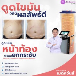 รีวิวดูดไขมันหน้าท้อง