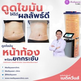 รีวิวดูดไขมันหน้าท้อง