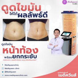 รีวิวดูดไขมันหน้าท้อง