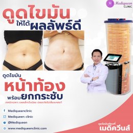 รีวิวดูดไขมันหน้าท้อง