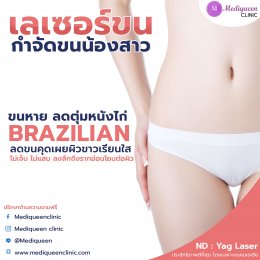  Long Pulse ND Yag Laser เลเซอร์กำจัดขนถาวร เพื่อผิวเรียบเนียน