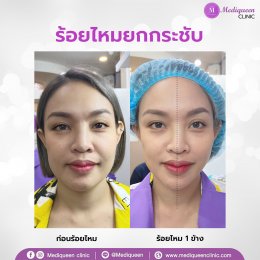  ร้อยไหม (Thread lift)  ยกกระชับปรับหน้าเรียว ดึงหน้าเด็ก