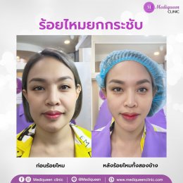  ร้อยไหม (Thread lift)  ยกกระชับปรับหน้าเรียว ดึงหน้าเด็ก