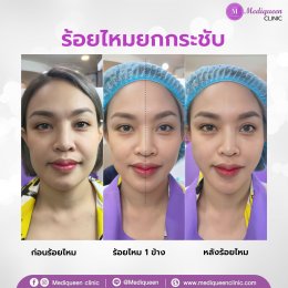  ร้อยไหม (Thread lift)  ยกกระชับปรับหน้าเรียว ดึงหน้าเด็ก