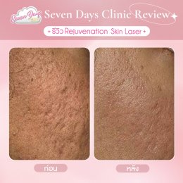 รีวิว Rejuvenation skin laser