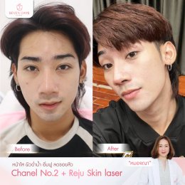 รีวิว Rejuvenation skin laser