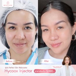 รีวิว Hycoox