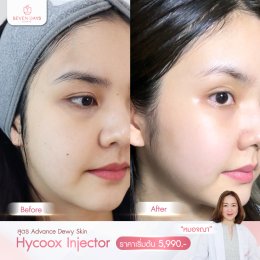 รีวิว Hycoox