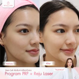 รีวิว PRP