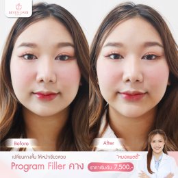 รีวิว Filler