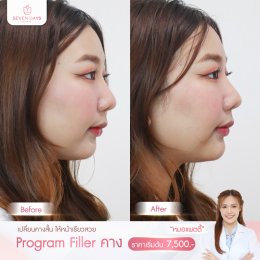 รีวิว Filler