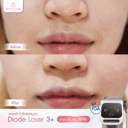 รีวิว Diode Laser กำจัดขน