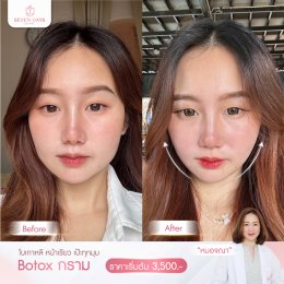 รีวิว Botox