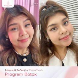 รีวิว Botox