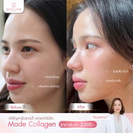 รีวิว Mesotherapy