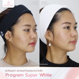 รีวิว Meso Super White