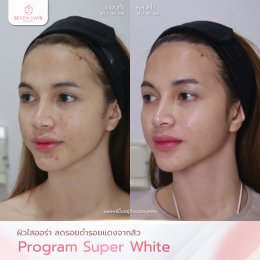 รีวิว Meso Super White