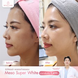 รีวิว Meso Super White