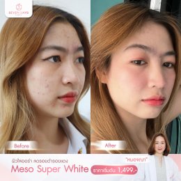 รีวิว Meso Super White