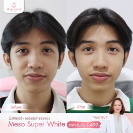 รีวิว Meso Super White