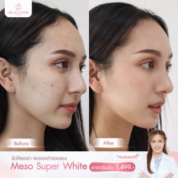 รีวิว Meso Super White