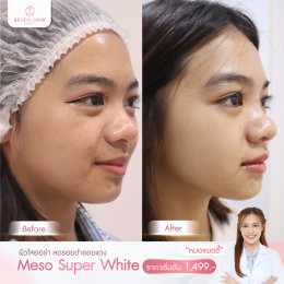 รีวิว Meso Super White