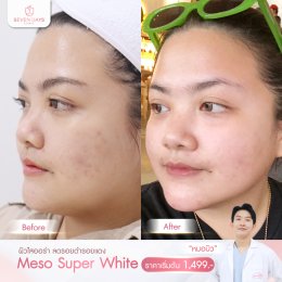 รีวิว Meso Super White