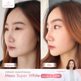 รีวิว Meso Super White