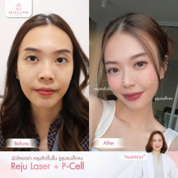 รีวิว Rejuvenation skin laser