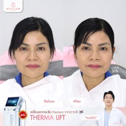 รีวิว Therma Lift