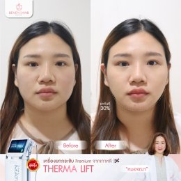 รีวิว Therma Lift