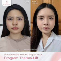 รีวิวโปรแกรม Therma Lift