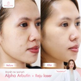 รีวิว Rejuvenation skin laser