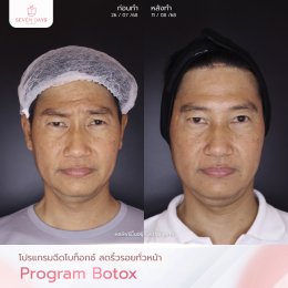 รีวิว Botox