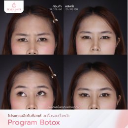 รีวิว Botox