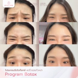 รีวิว Botox