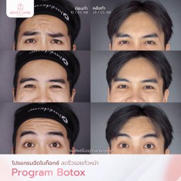 รีวิว Botox