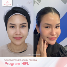 รีวิวโปรแกรม Hifu