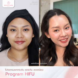 รีวิวโปรแกรม Hifu