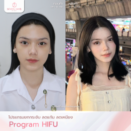 รีวิวโปรแกรม Hifu
