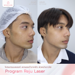 รีวิว Rejuvenation skin laser