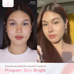 รีวิวโปรแกรม  Skin Bright