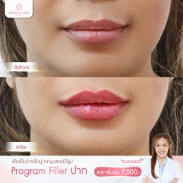 รีวิว Filler