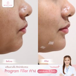 รีวิว Filler