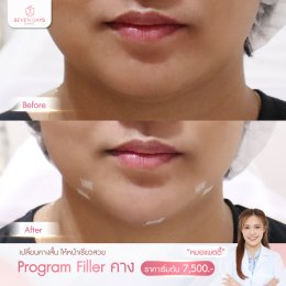 รีวิว Filler