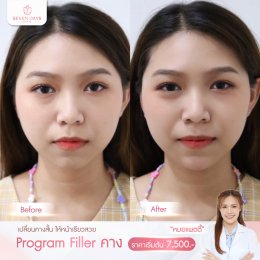 รีวิว Filler