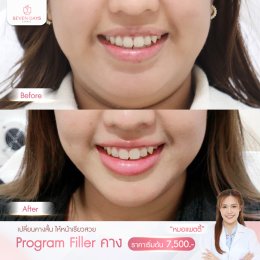 รีวิว Filler